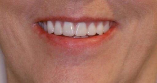 Smile case 1 after treatment