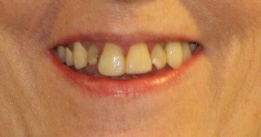 Smile case 1 before treatment