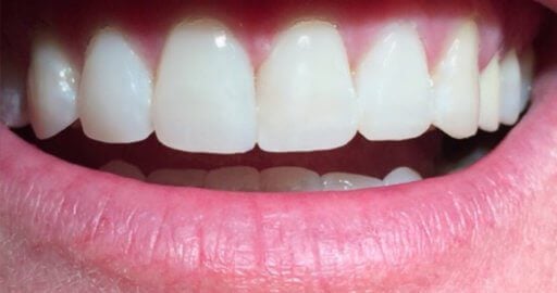 Smile case 2 after treatment
