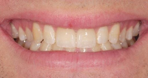 Smile case 3 after treatment