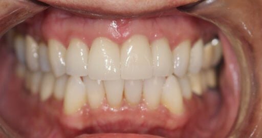 Smile case 4 after treatment