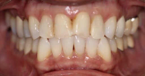 Smile case 4 before treatment