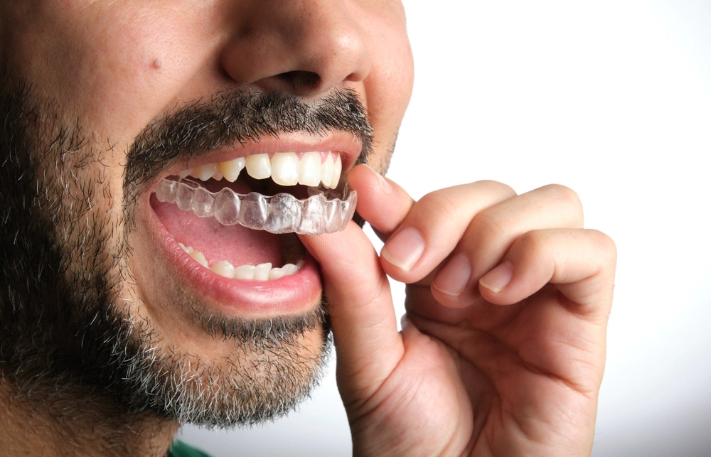 Custom dental mouthguard at Mesa Dental Group
